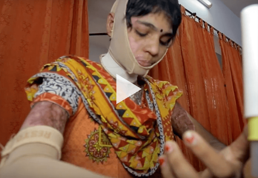 Woman with burn injuries